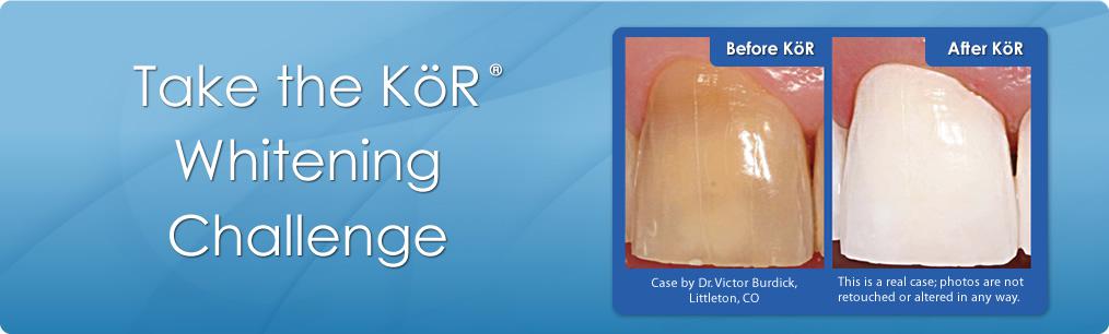 KOR Whitening service in Fort Myers